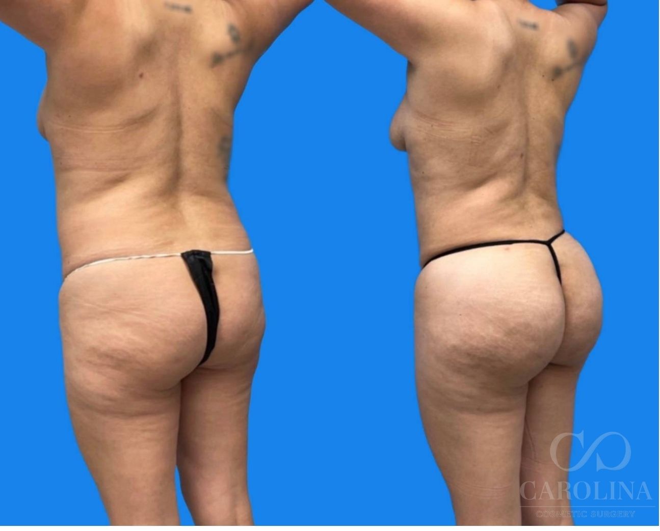 Case--3729 | Before and After Lipo 360 4
