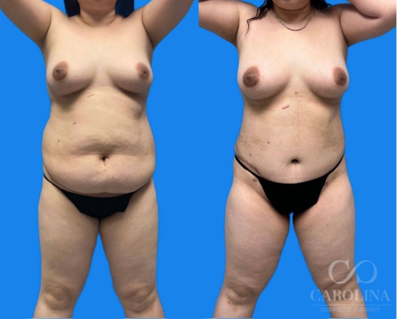 Case--4702 | Before and After Tummy Tuck