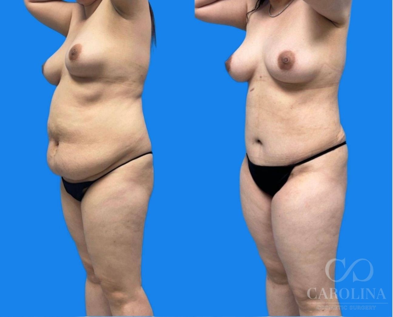 Case--4702 | Before and After Tummy Tuck 2