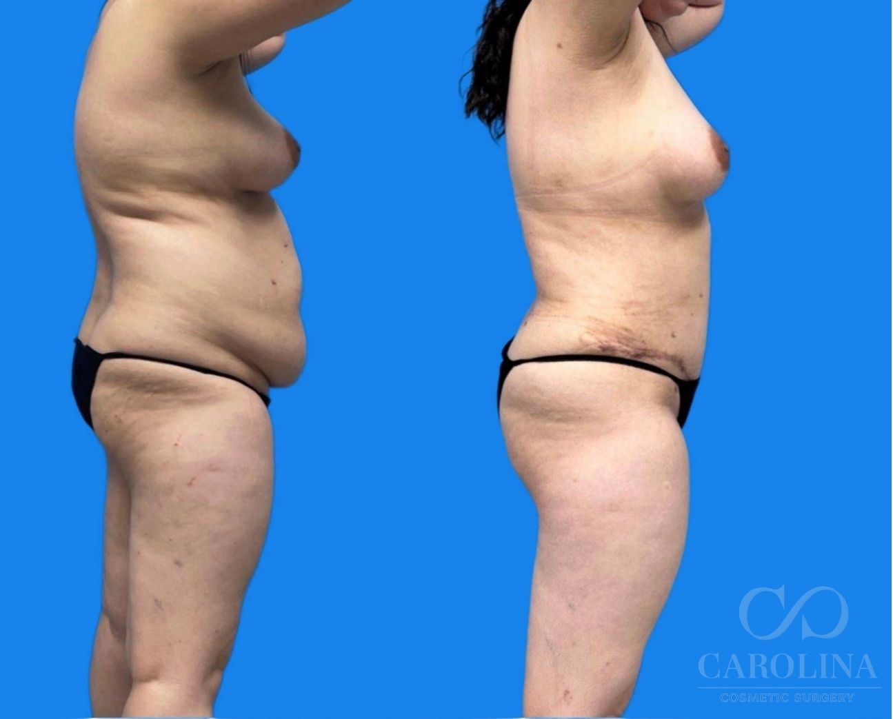Case--4702 | Before and After Tummy Tuck 4
