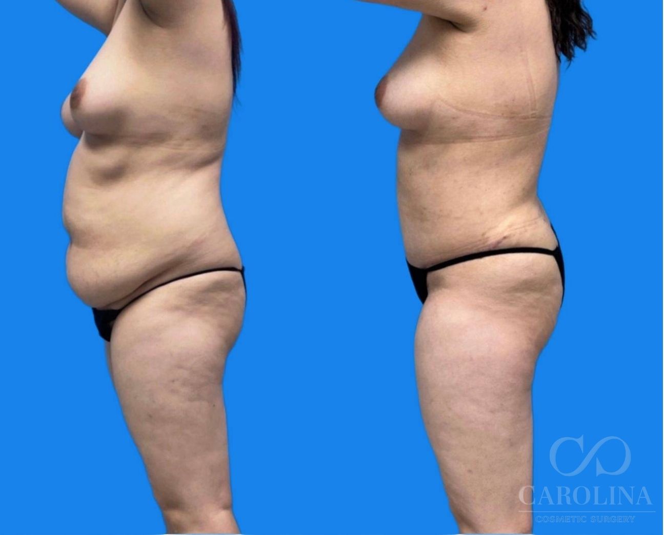 Case--1024 | Before and After Tummy Tuck 4