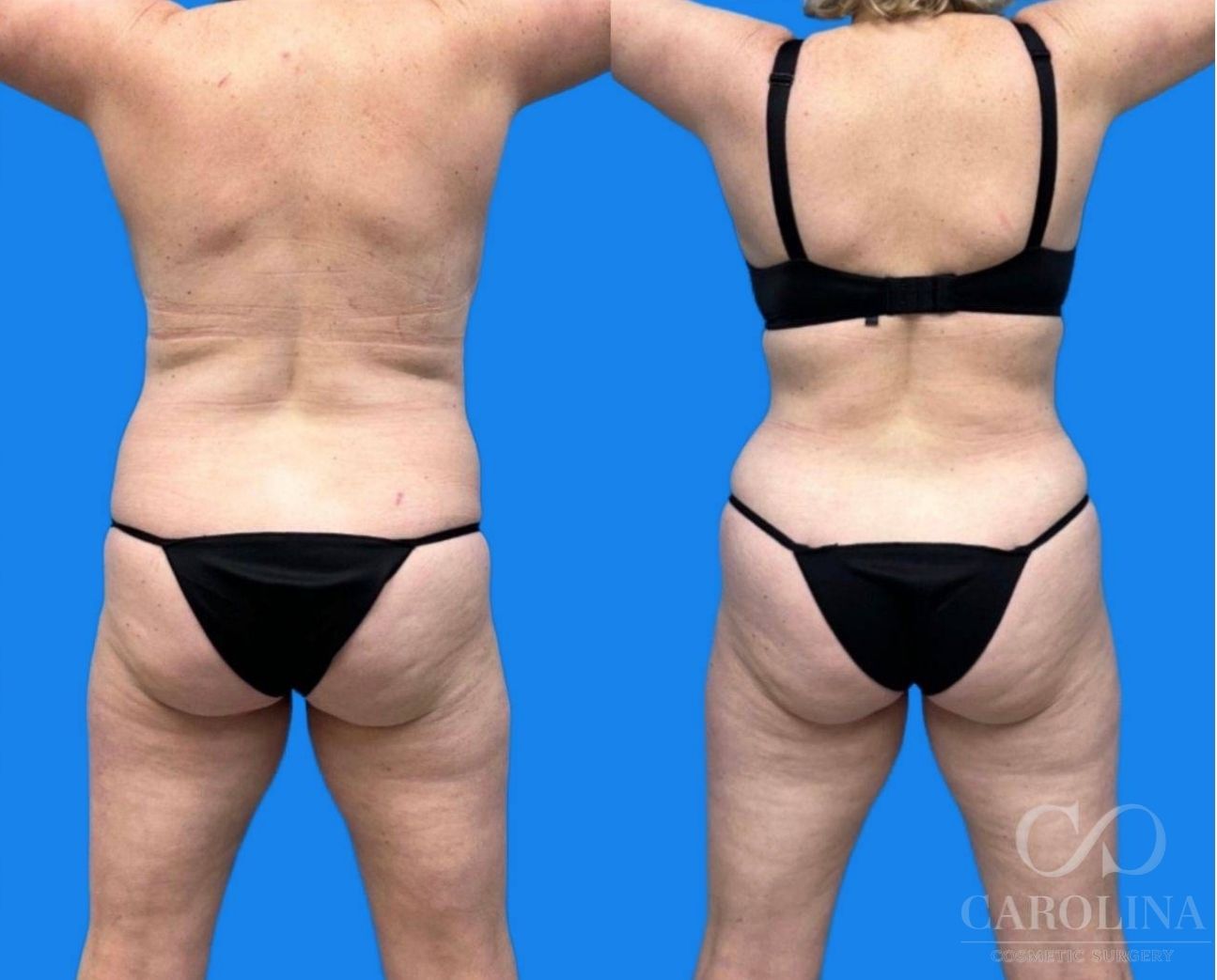 Case--1024 | Before and After Tummy Tuck 5