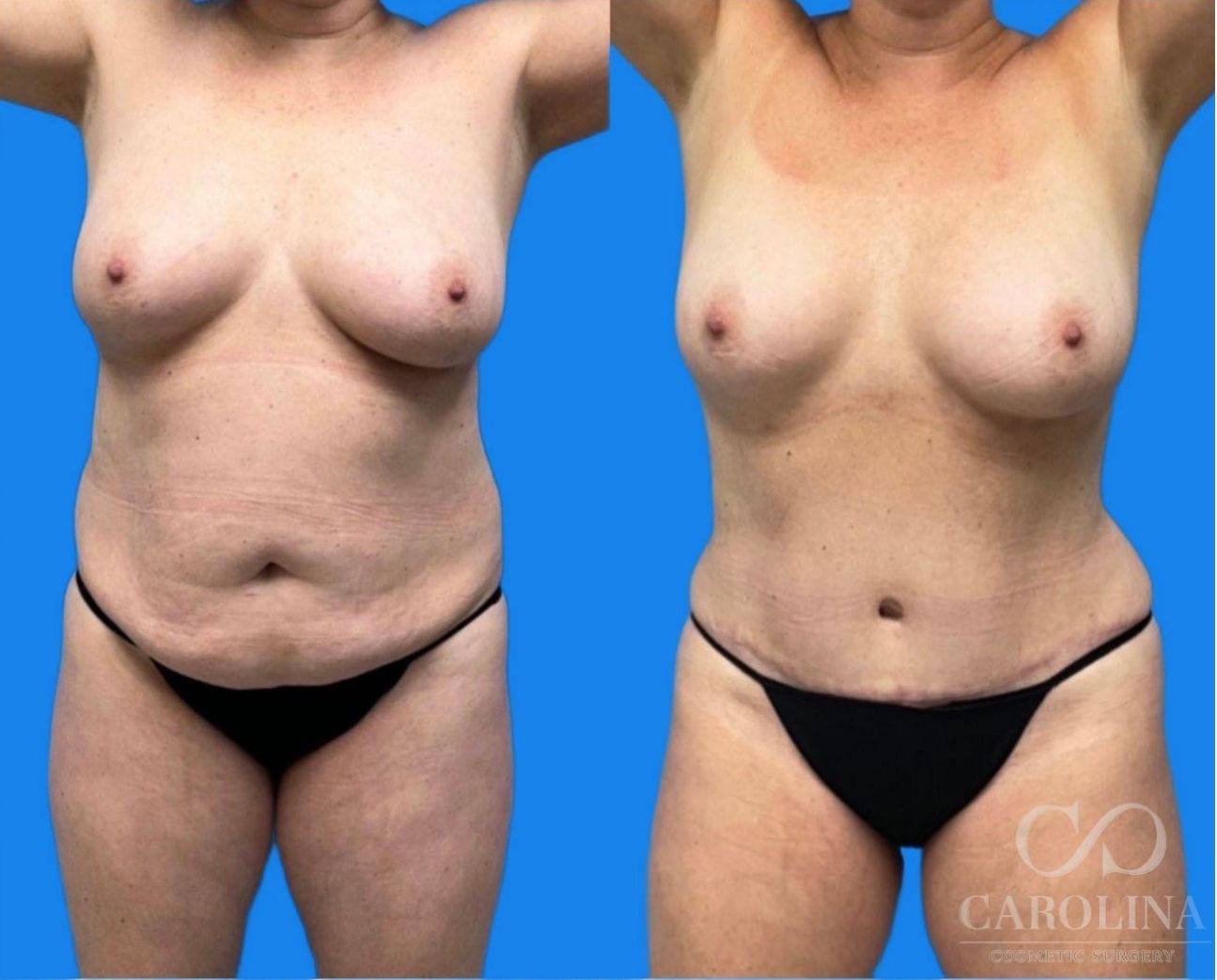 Case--1024 | Before and After Tummy Tuck 2