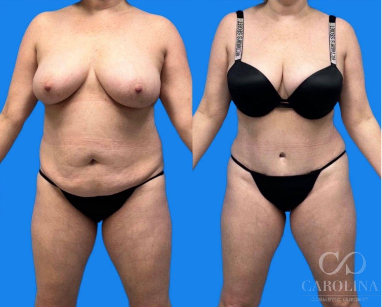 Case--1024 | Before and After Tummy Tuck