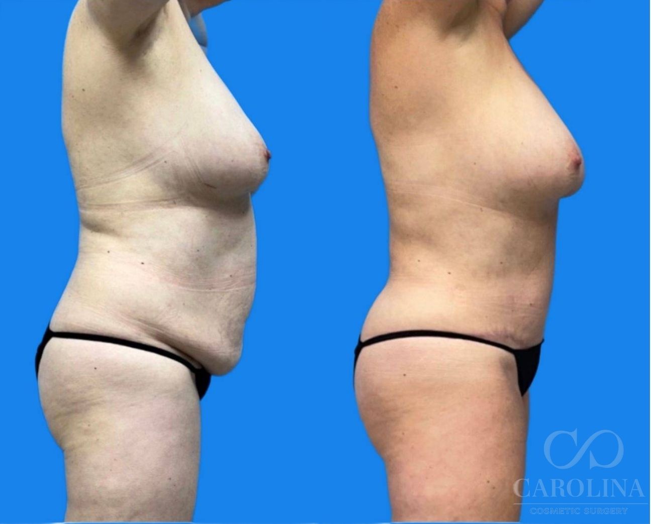 Case--1024 | Before and After Tummy Tuck 3