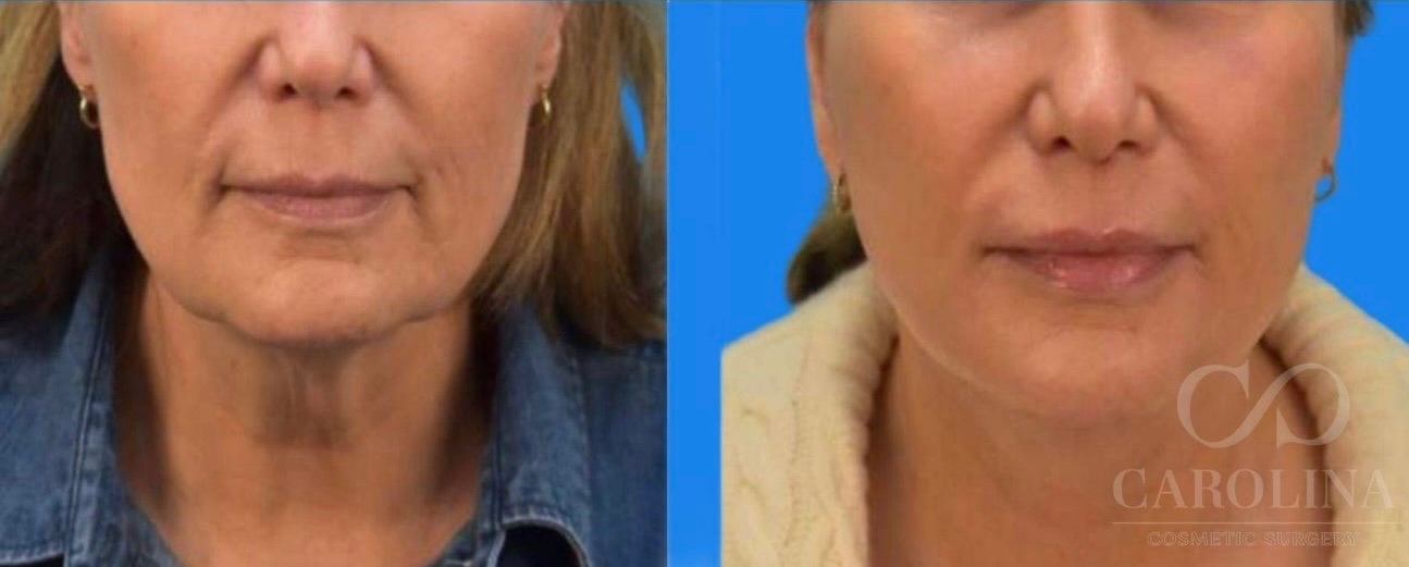 Case--7856 | Before and After Face/Neck Lift