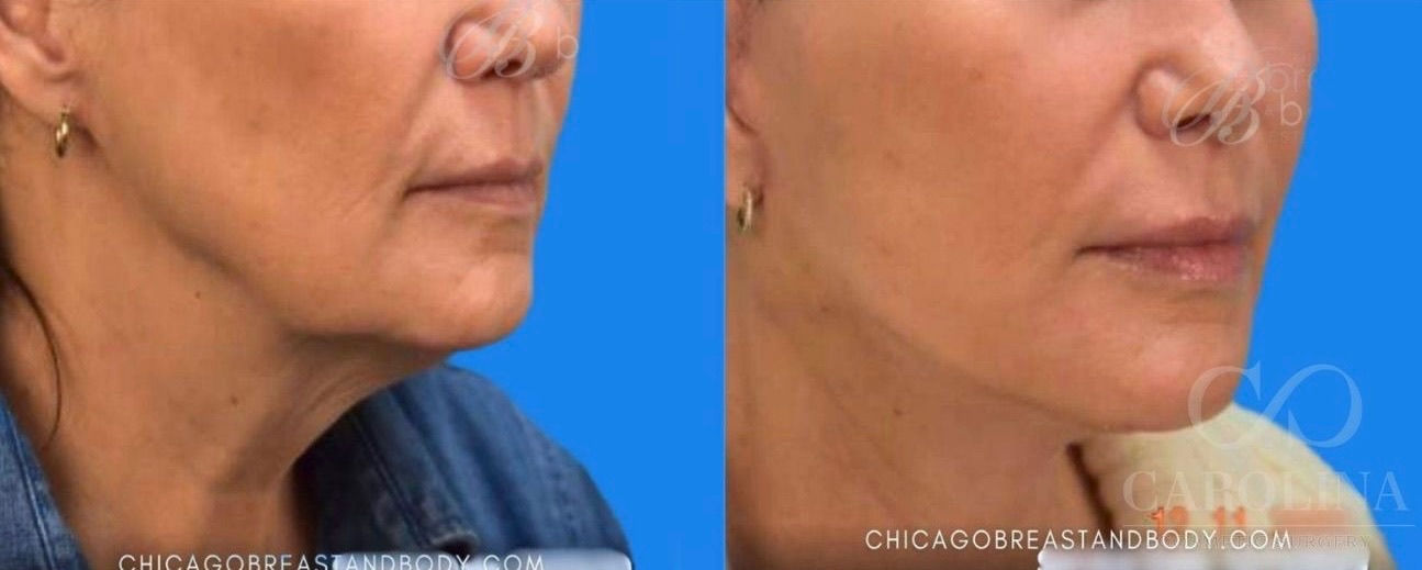Case--7856 | Before and After Face/Neck Lift 2