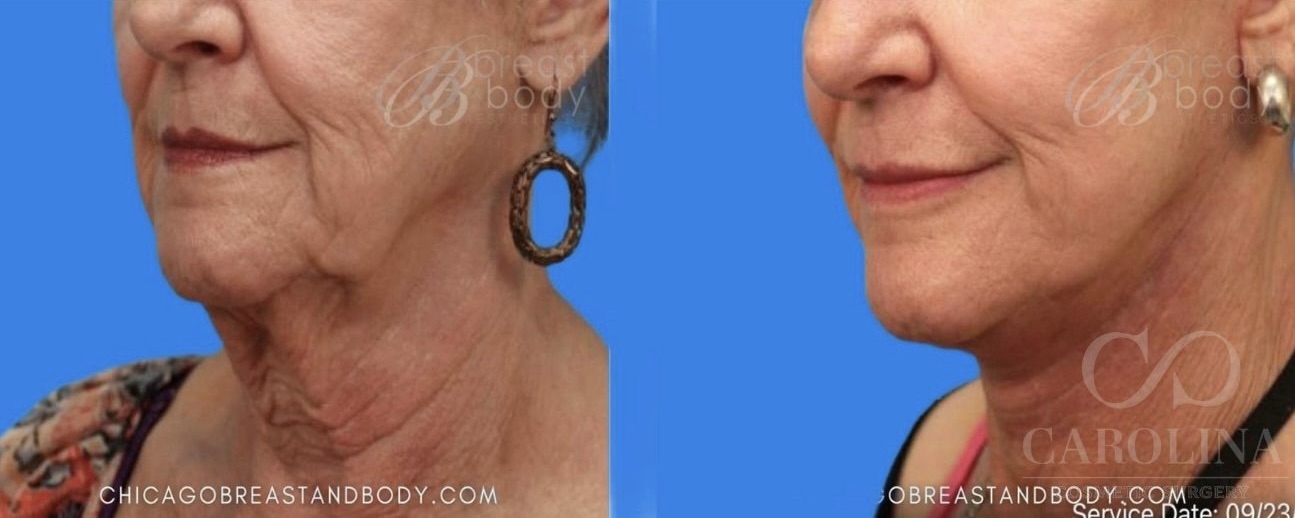 Case--4032 | Before and After Face/Neck Lift 2
