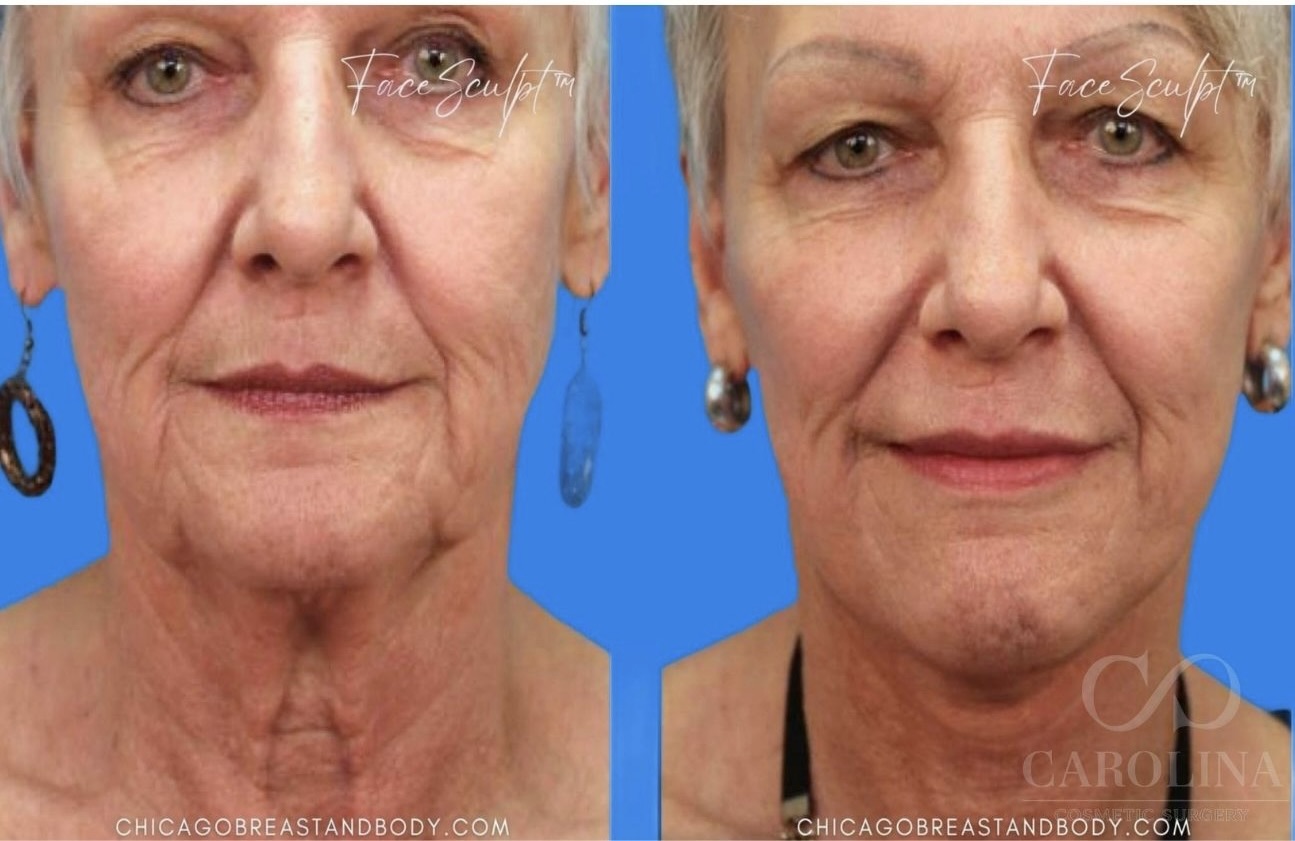 Case--4032 | Before and After Face/Neck Lift