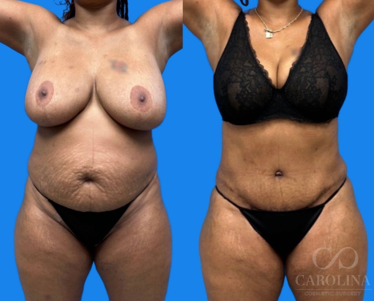 Case--8803 | Before and After Tummy Tuck 2
