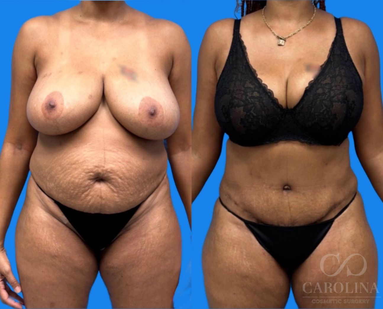 Case--8803 | Before and After Tummy Tuck