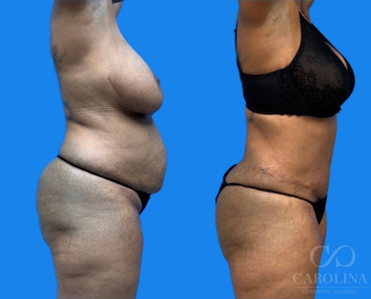 Case--8803 | Before and After Tummy Tuck 3