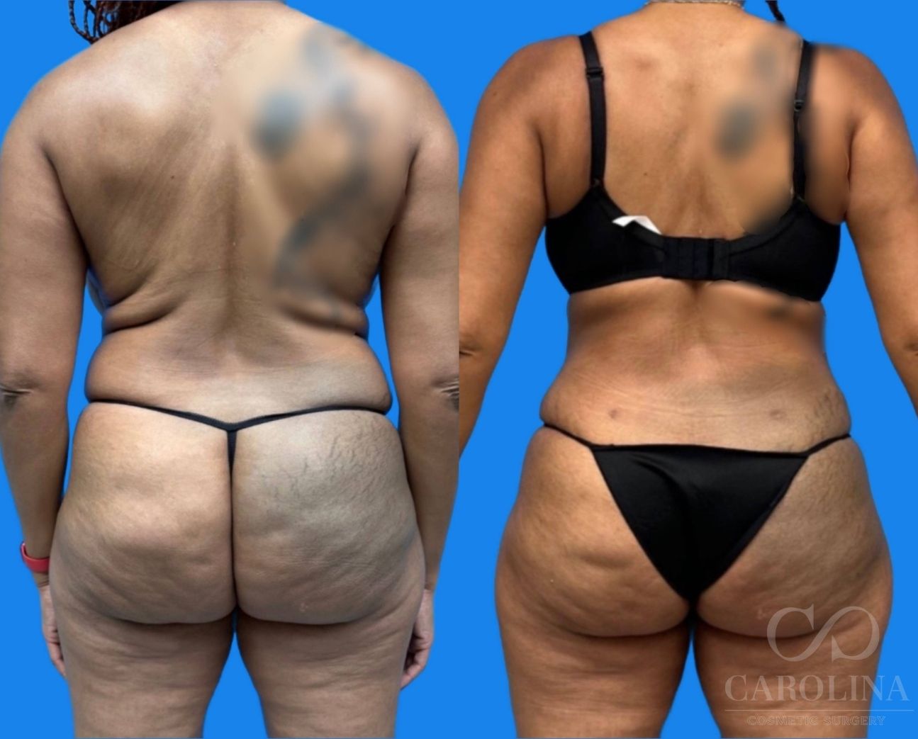 Case--8803 | Before and After Tummy Tuck 4