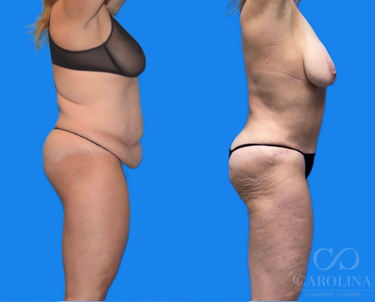 Case--7855 | Before and After Tummy Tuck 3