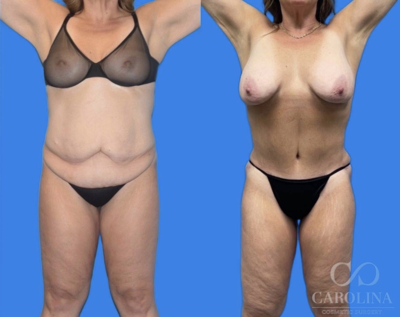 Case--7855 | Before and After Tummy Tuck