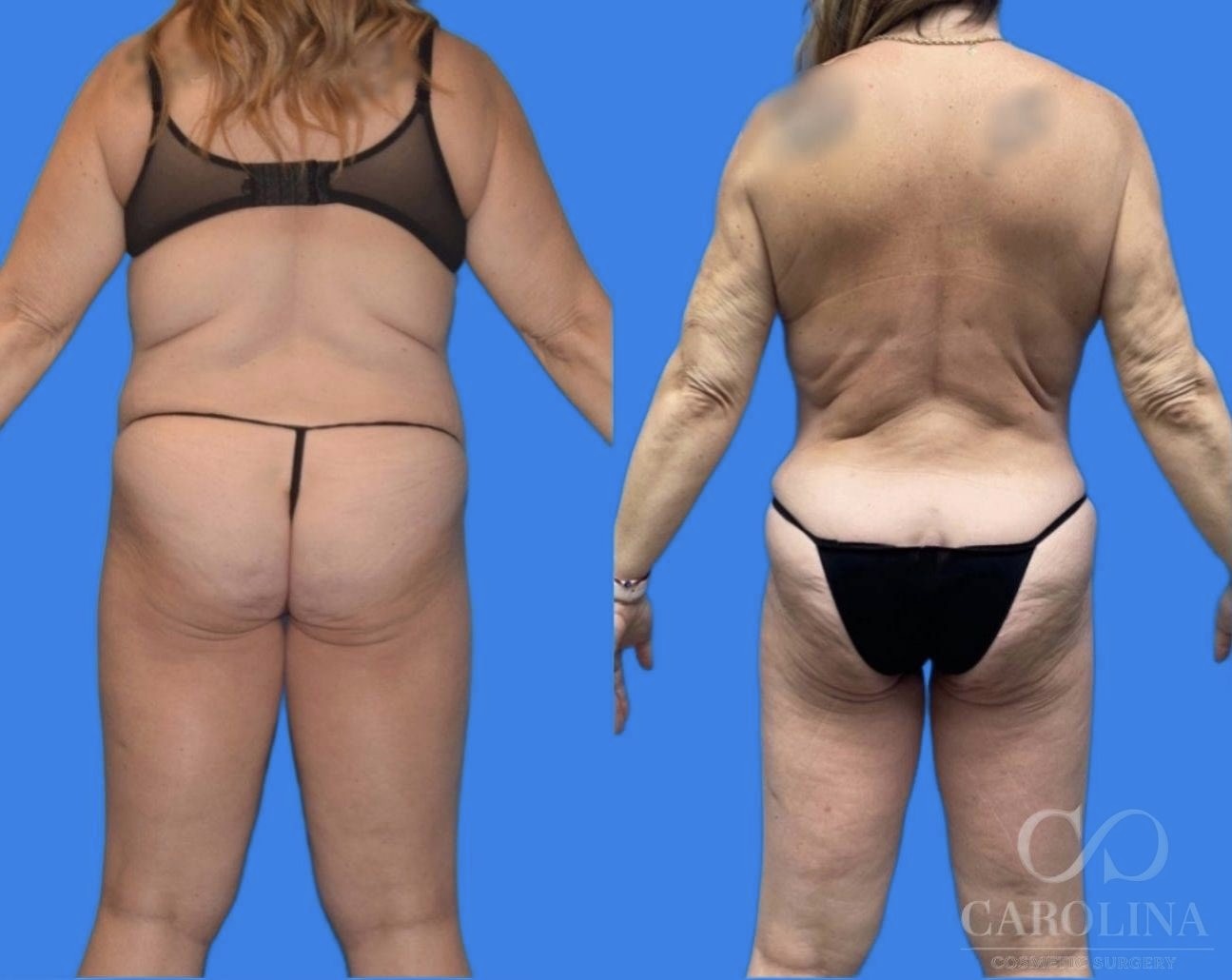Case--7855 | Before and After Tummy Tuck 4