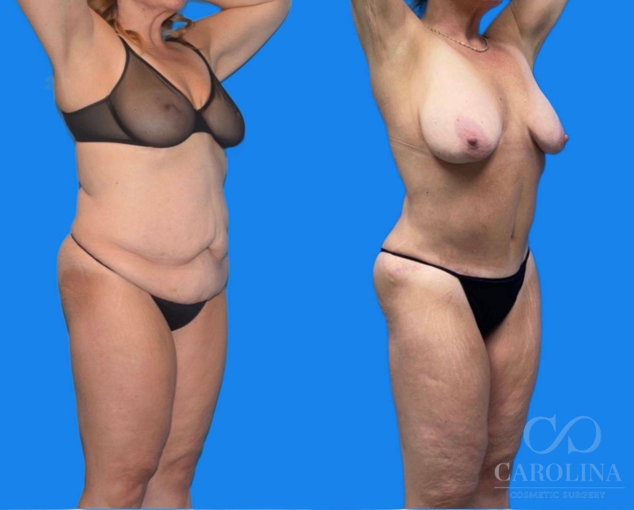 Case--7855 | Before and After Tummy Tuck 2