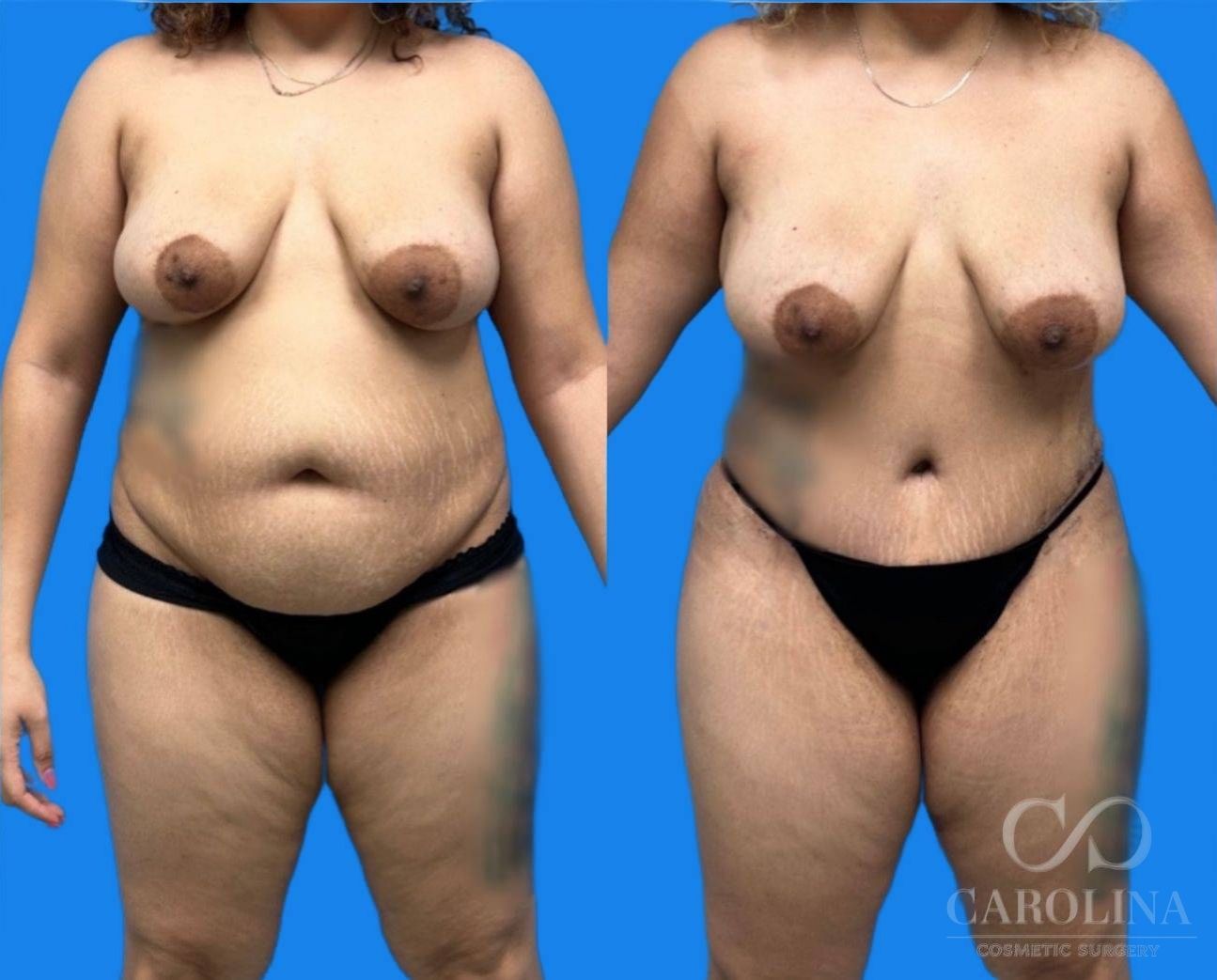 Case--9439 | Before and After Tummy Tuck