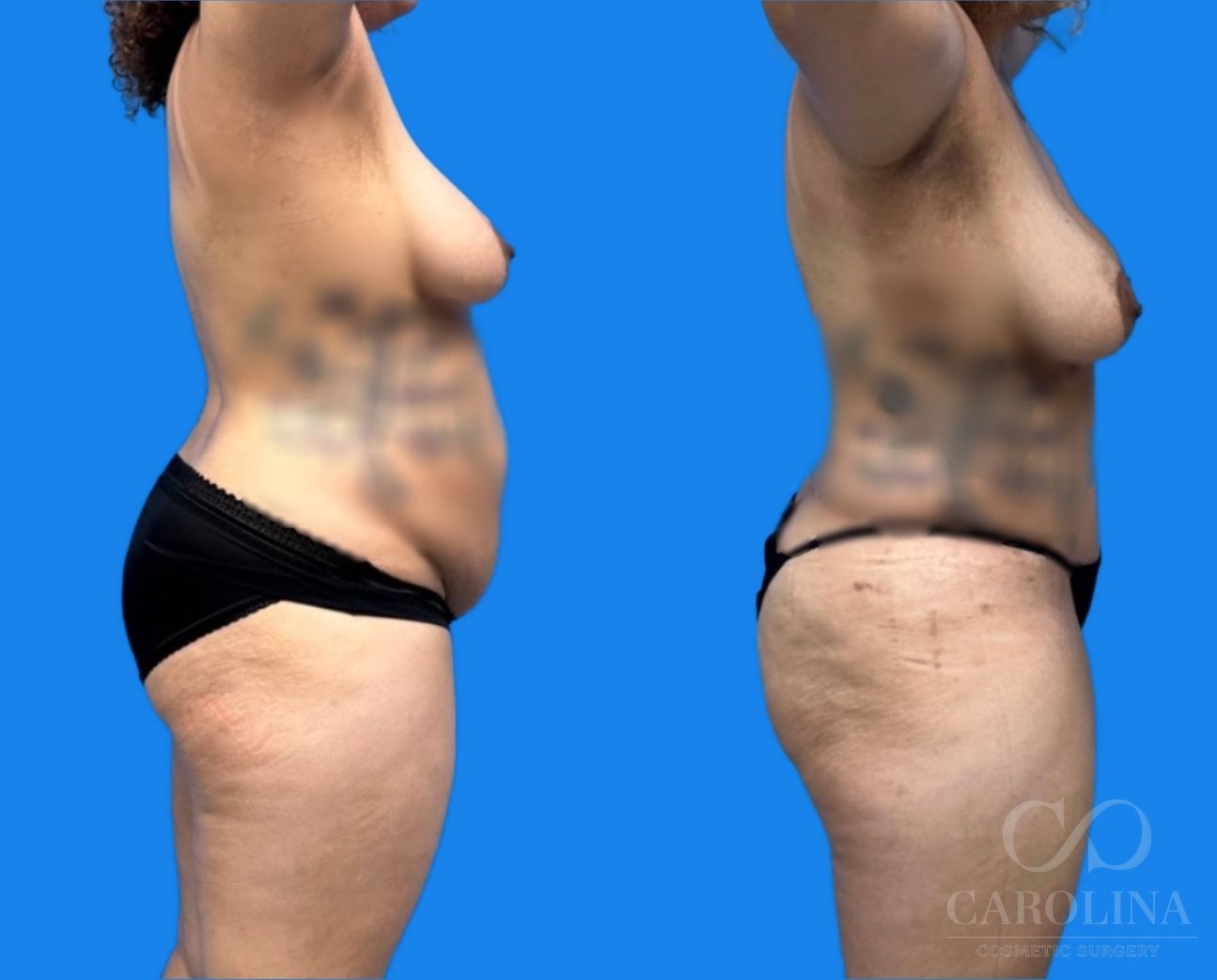 Case--9439 | Before and After Tummy Tuck 3