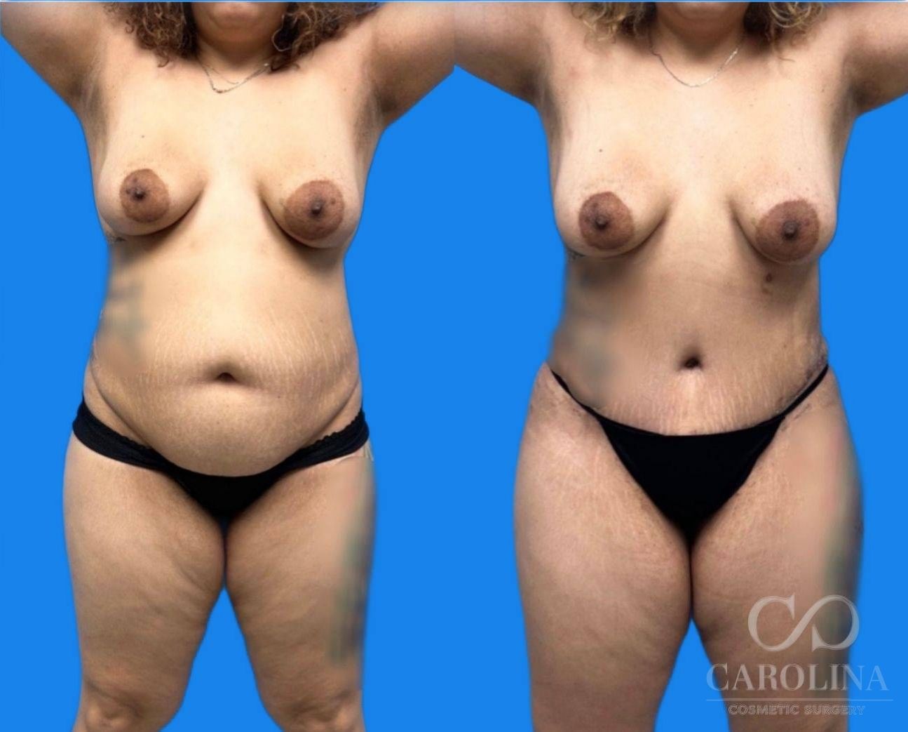 Case--9439 | Before and After Tummy Tuck 2
