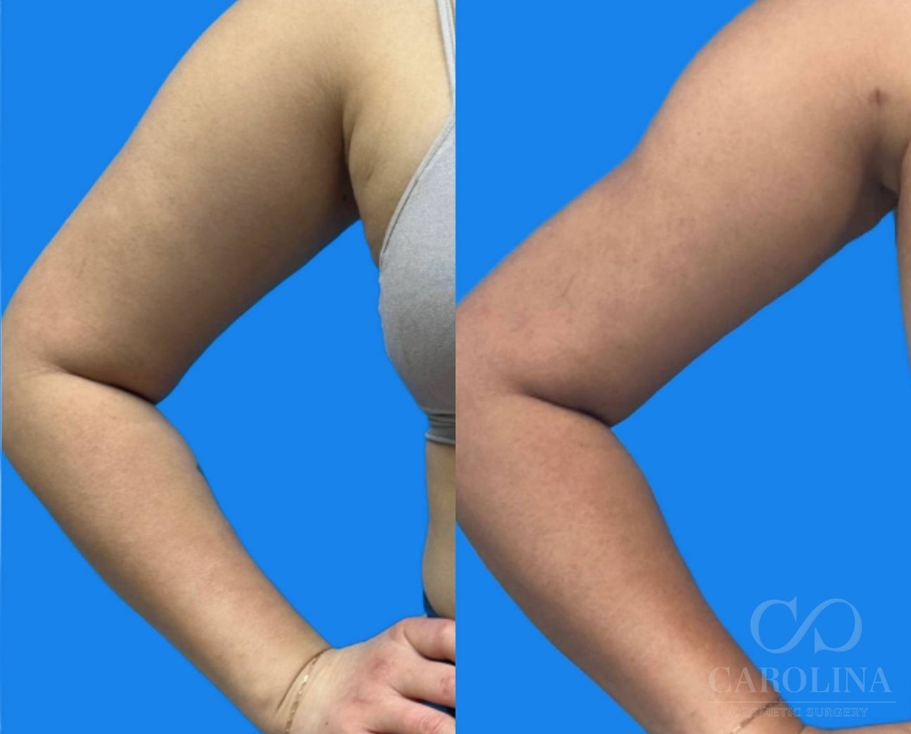 Case--6433 | Before and After Arm Sculpt 4