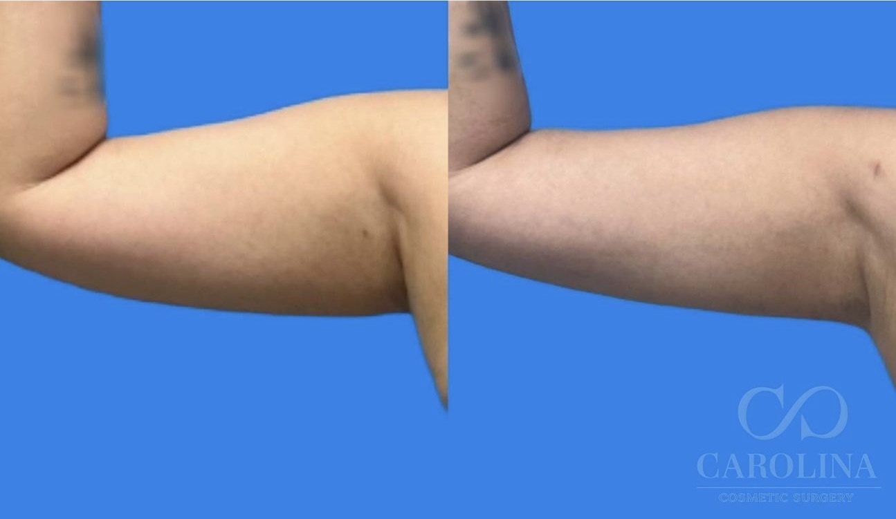 Case--6433 | Before and After Arm Sculpt 8