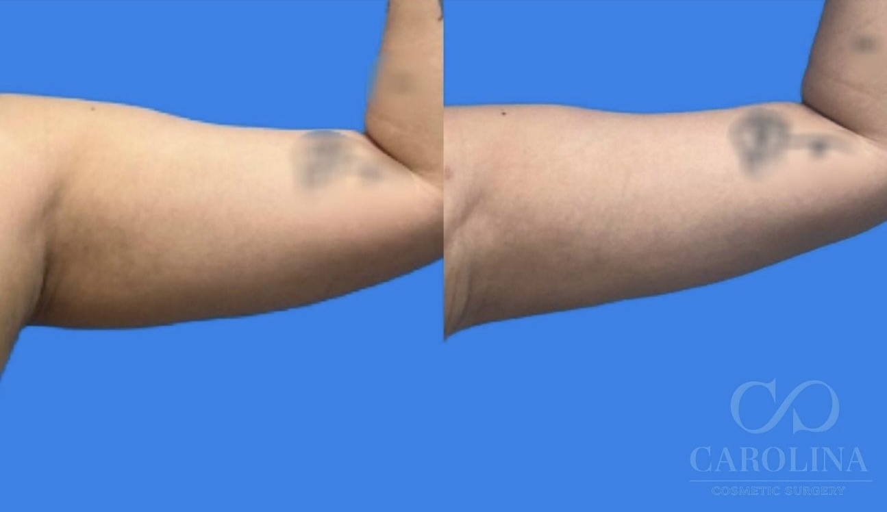 Case--6433 | Before and After Arm Sculpt 9