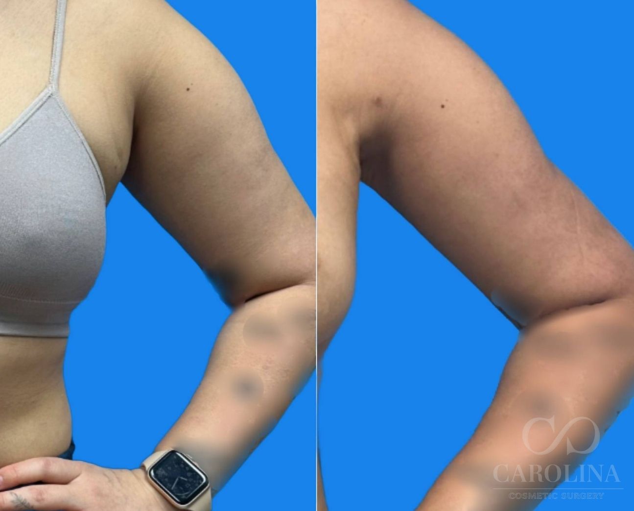 Case--6433 | Before and After Arm Sculpt 5