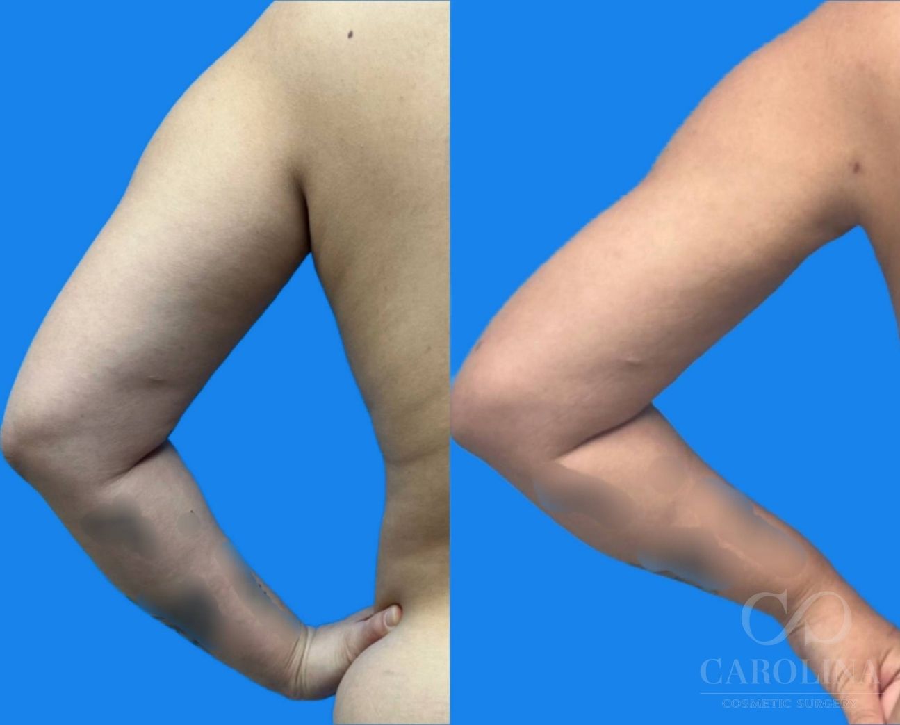 Case--6433 | Before and After Arm Sculpt 6