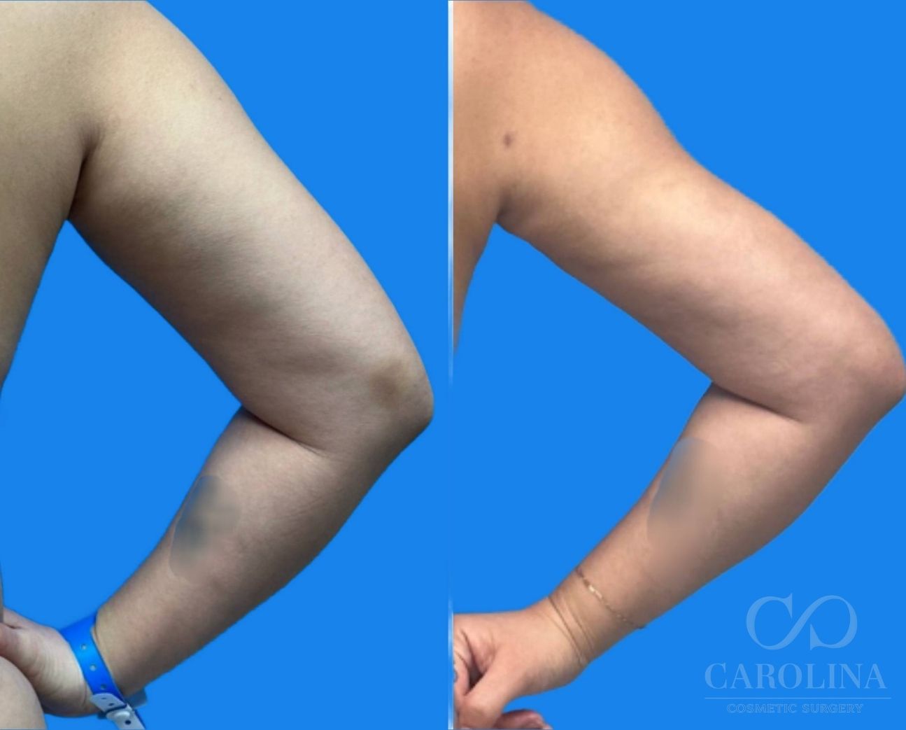 Case--6433 | Before and After Arm Sculpt 7