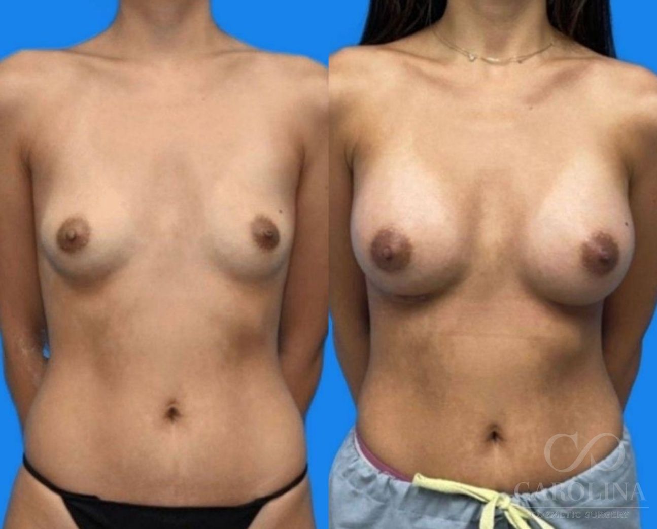 Case--3434 | Before and After Breast Augmentation