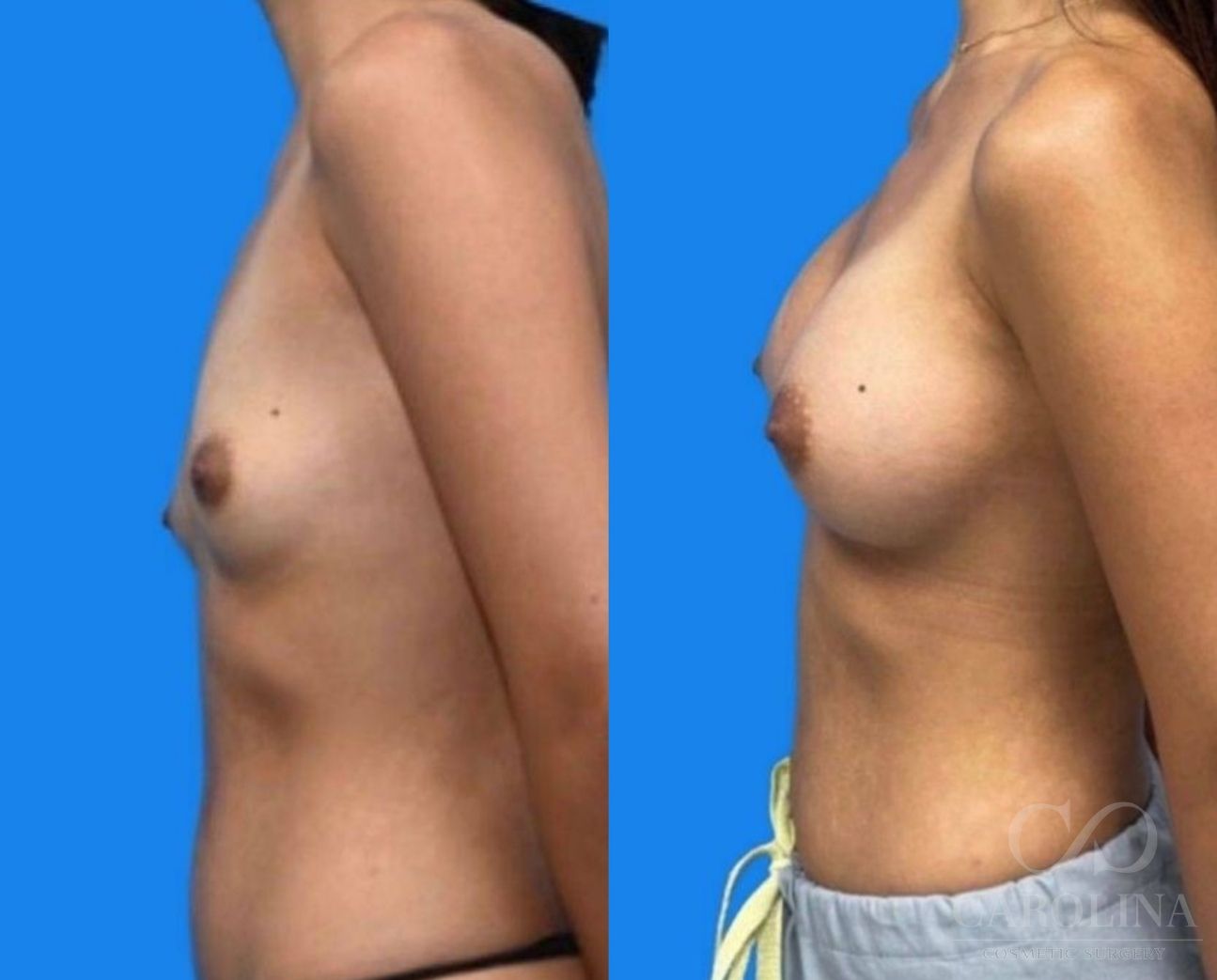 Case--3434 | Before and After Breast Augmentation 3