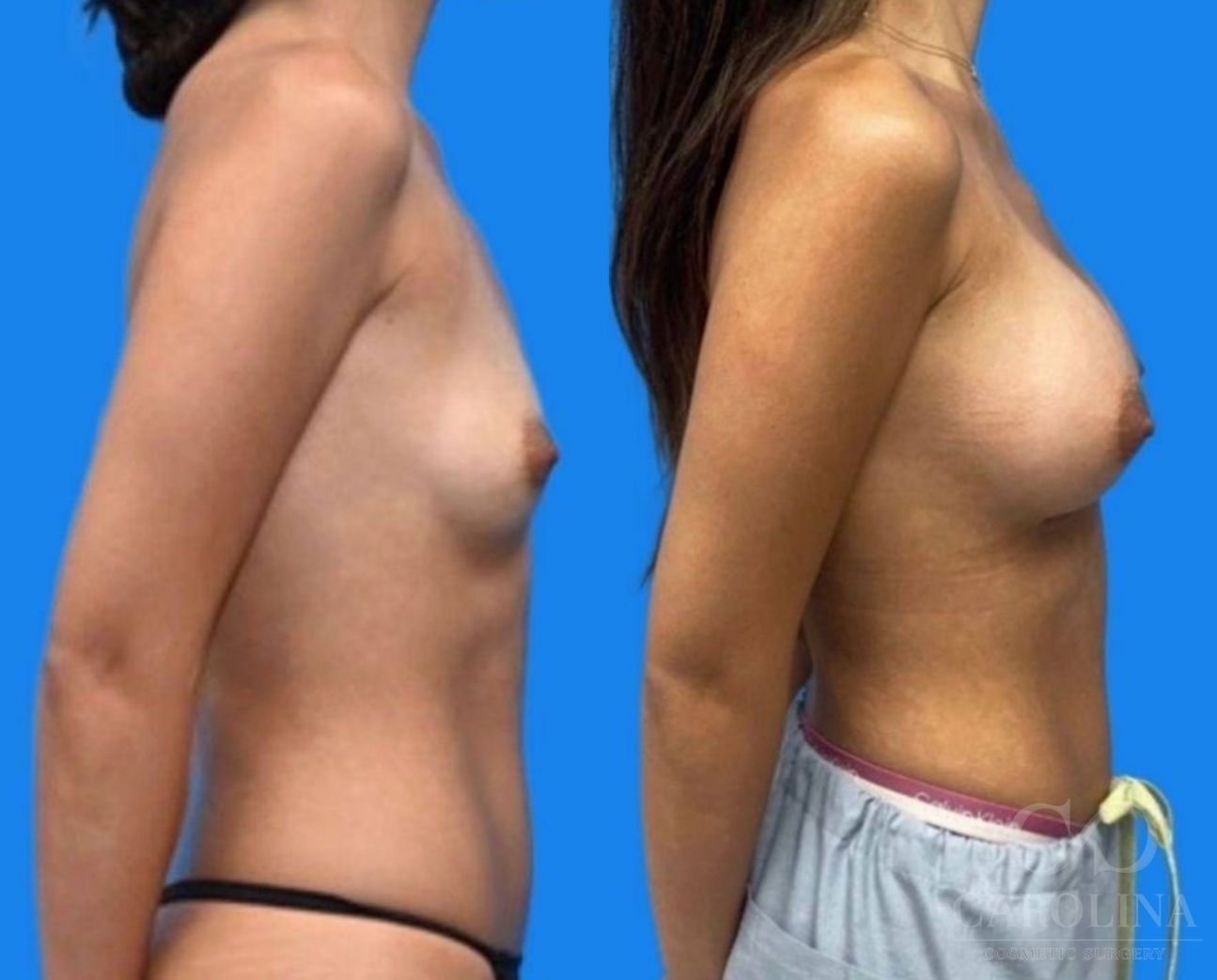 Case--3434 | Before and After Breast Augmentation 2