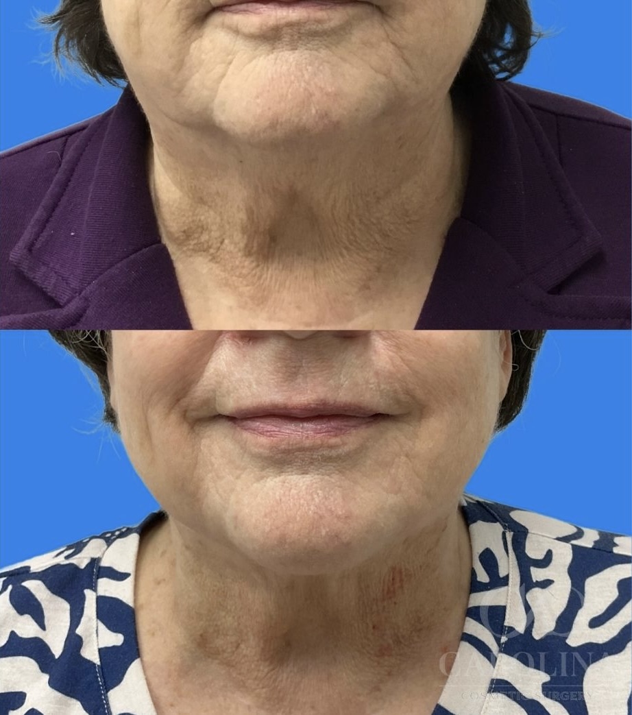 Case--9805 | Before and After Face