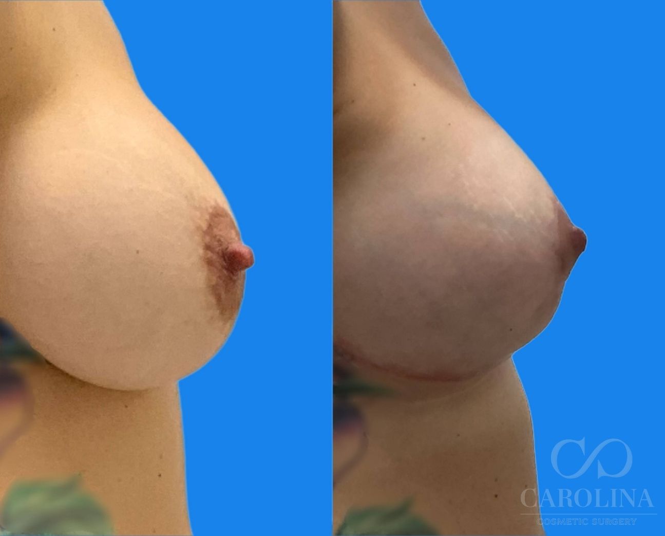 Case--6711 | Before and After Breast Augmentation 6