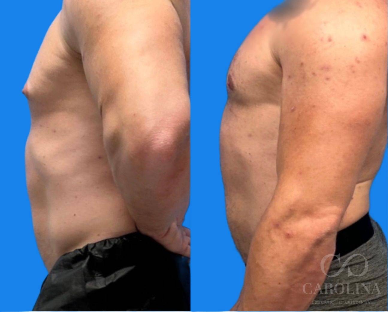 Case--2968 | Before and After Gynecomastia 2