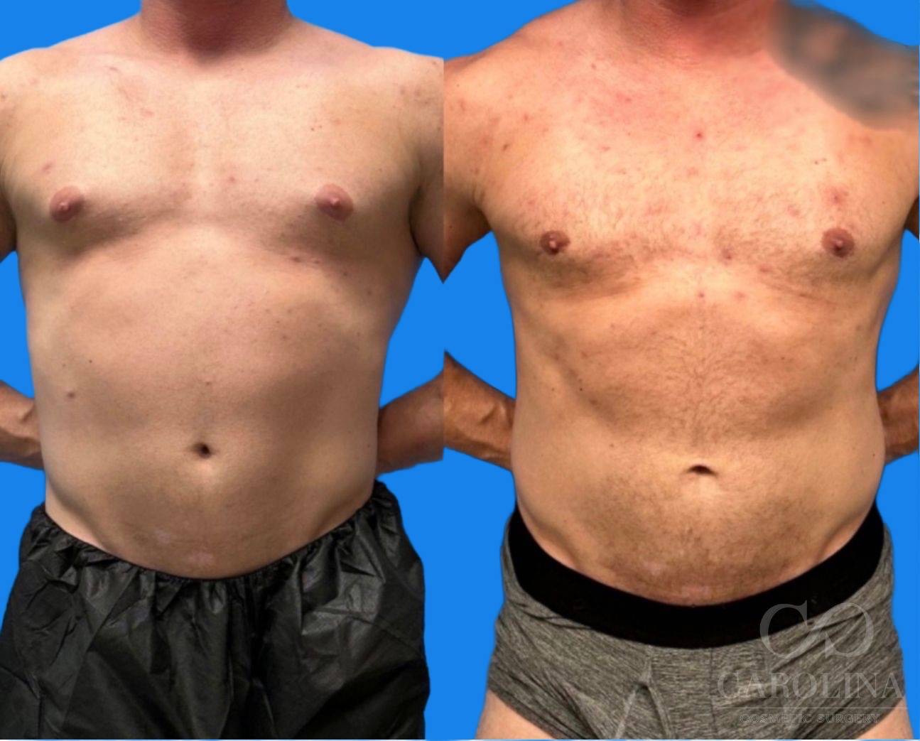 Case--2968 | Before and After Gynecomastia