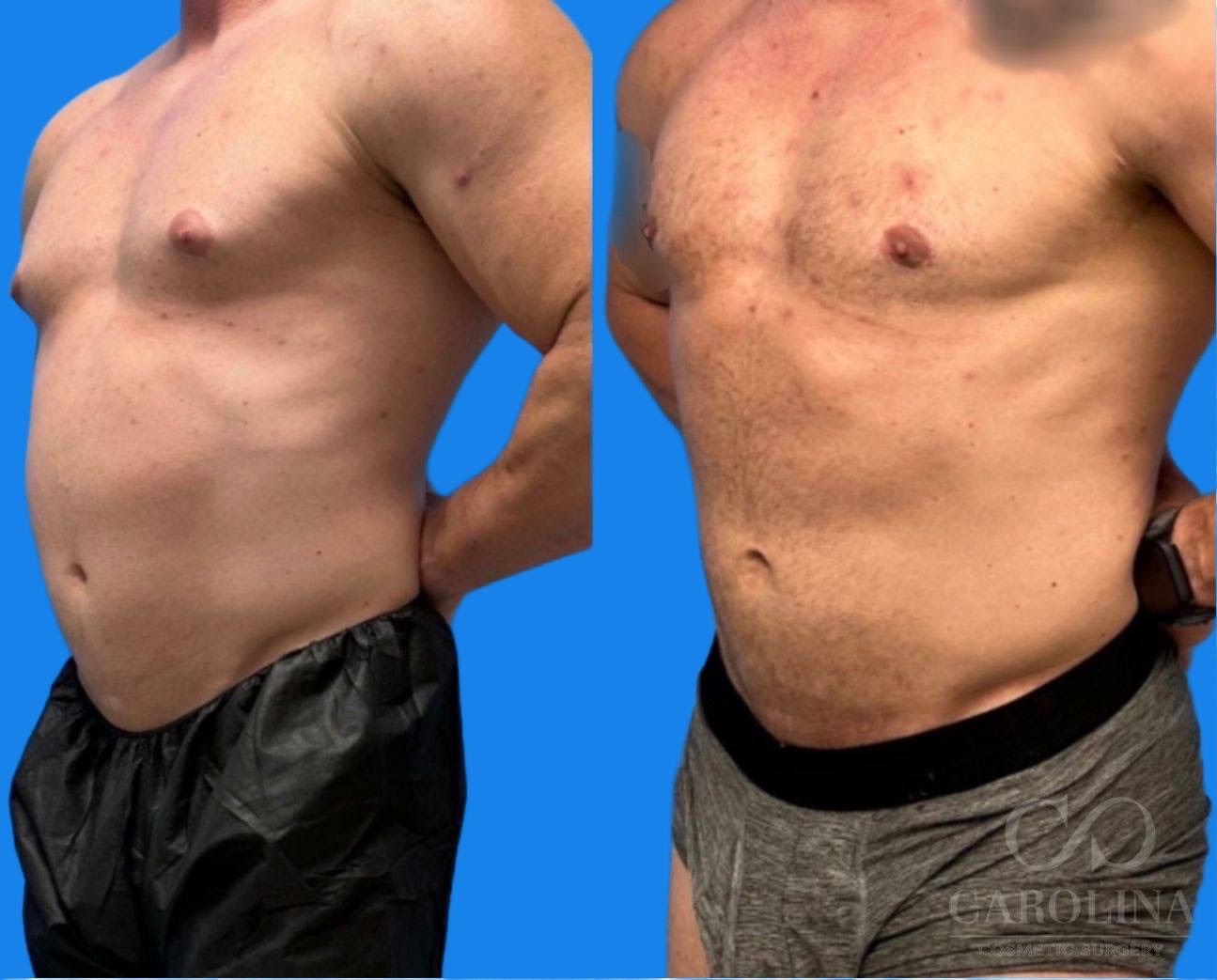 Case--2968 | Before and After Gynecomastia 3