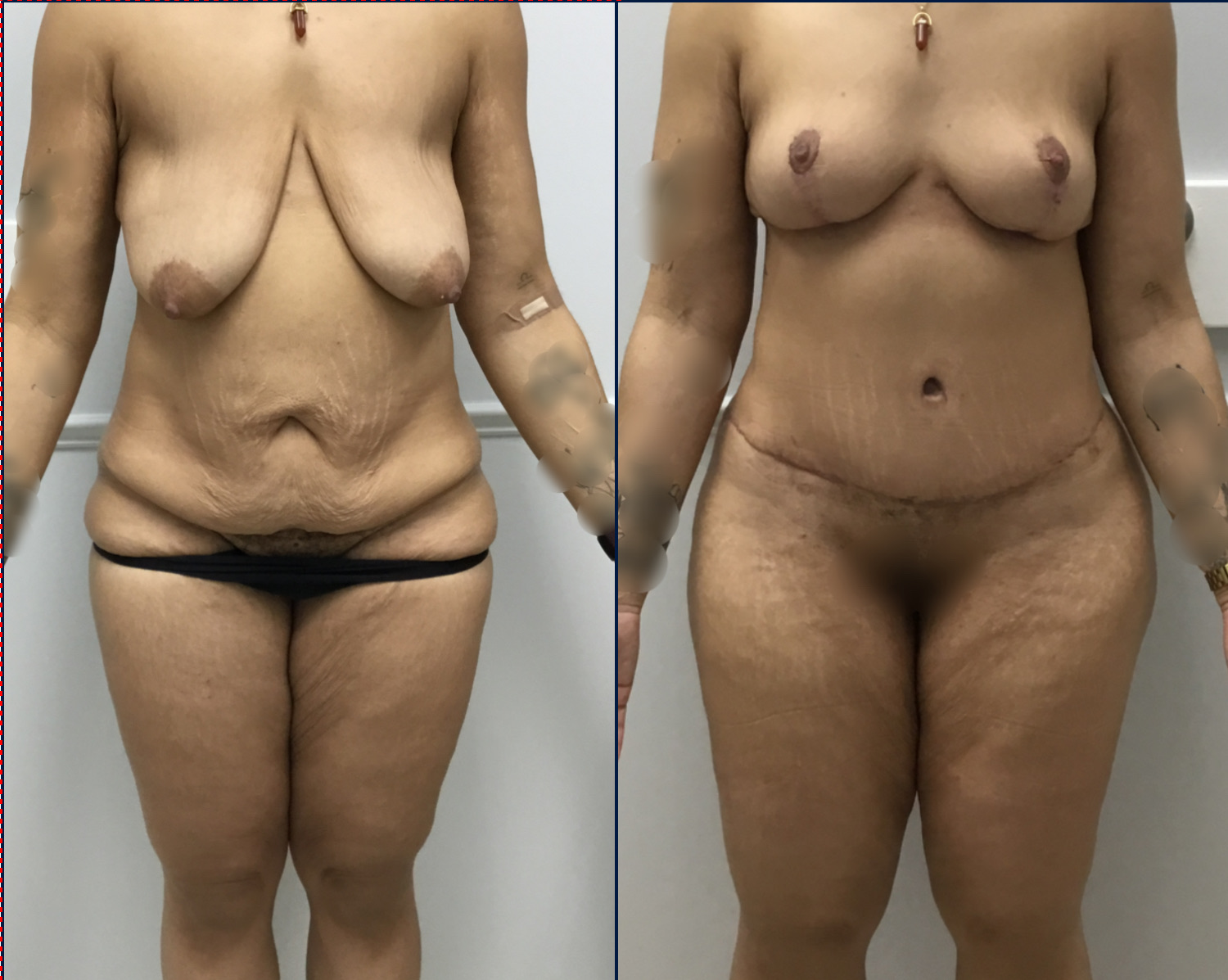 Case--8013A | Before and After Tummy Tuck