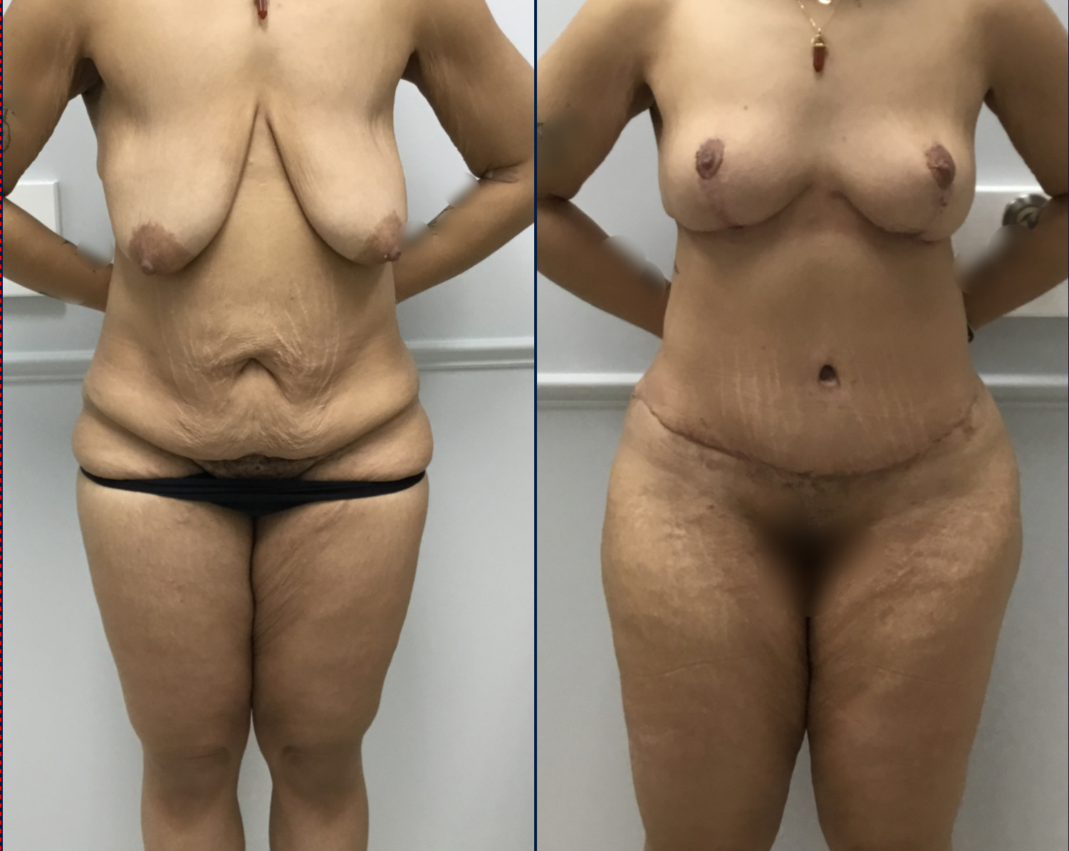 Case--8013 | Before and After Breast Lift 2