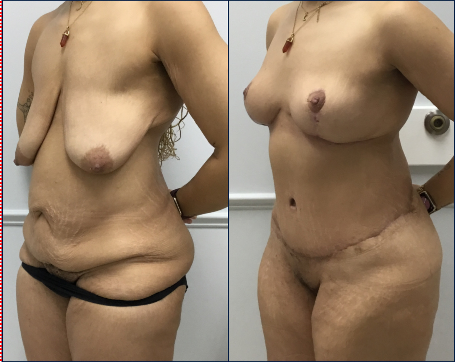 Case--8013 | Before and After Breast Lift 3