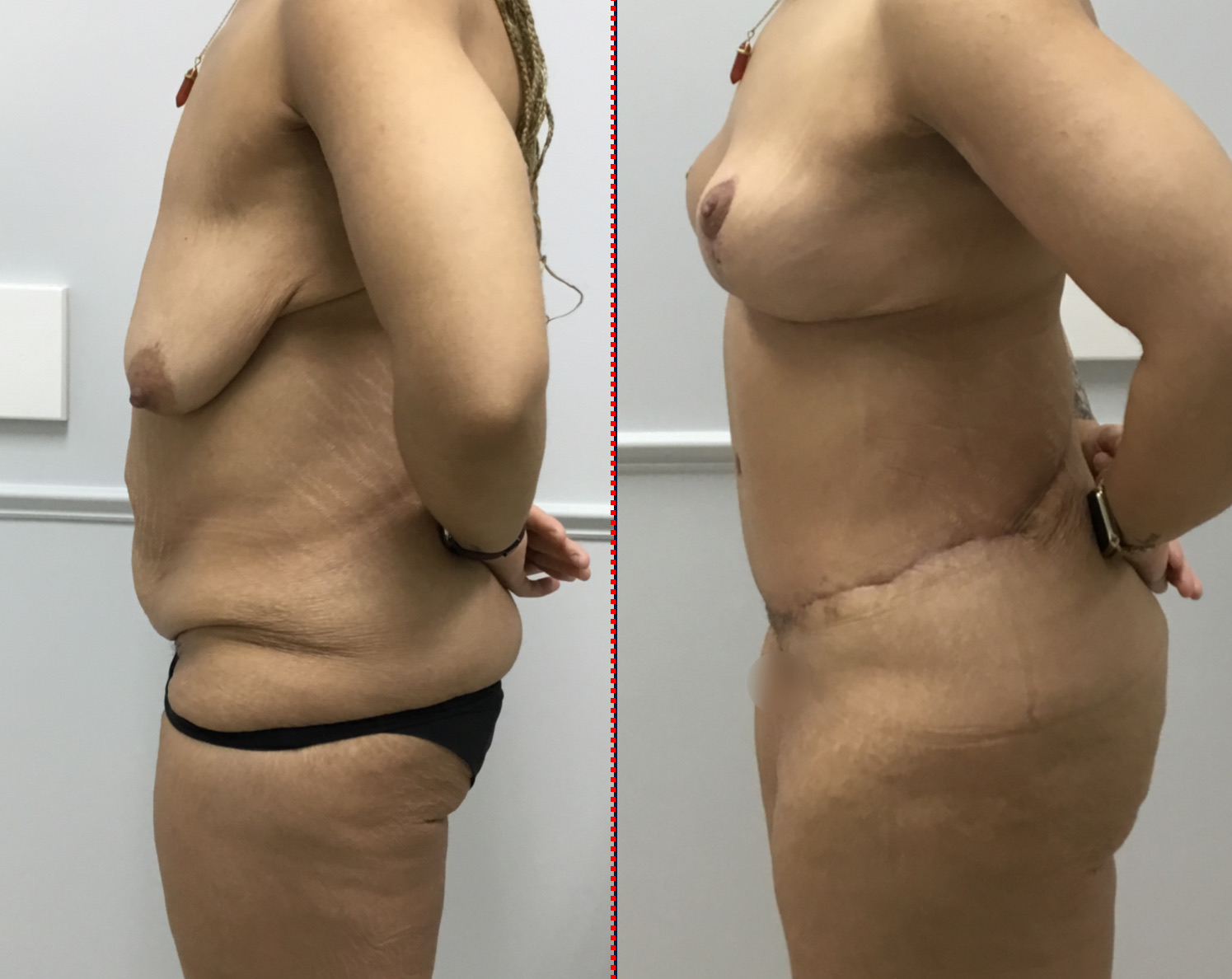 Case--8013 | Before and After Breast Lift 4