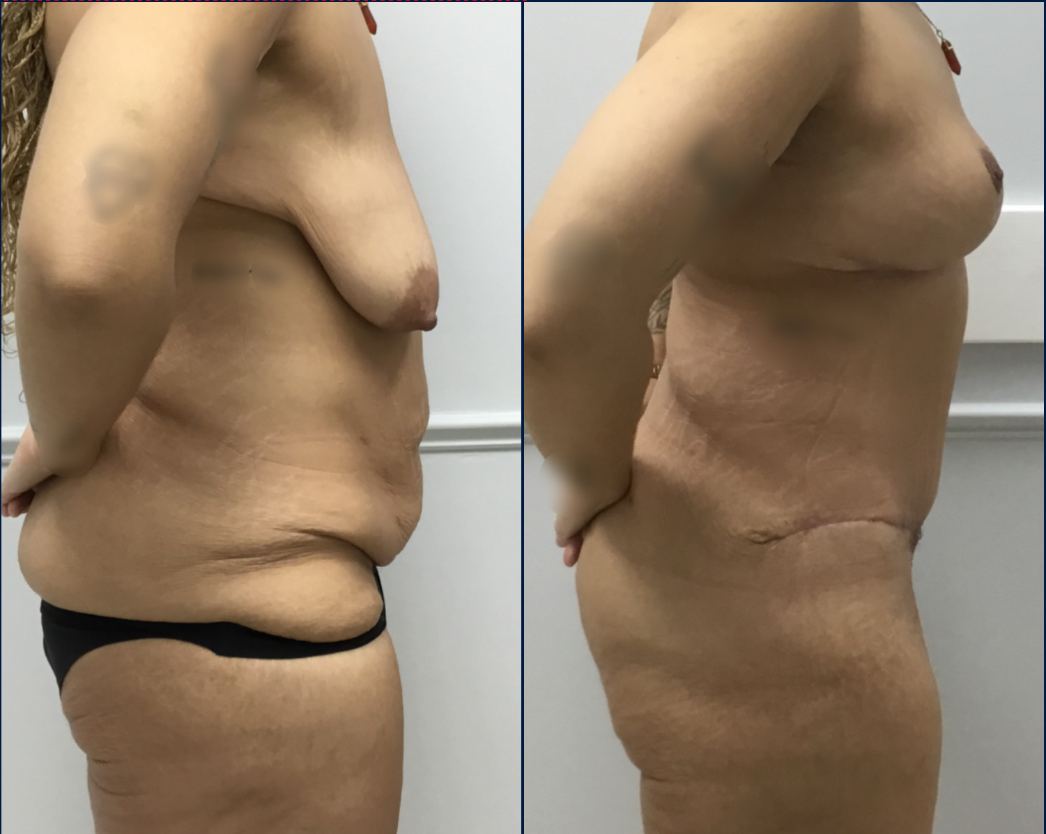 Case--8013 | Before and After Breast Lift 5