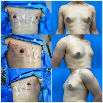 Grade 2 Gynecomastia with Liposuction and Renuvion