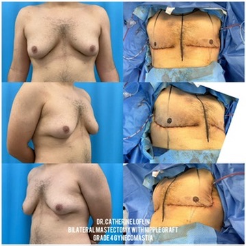 Case--2571 | Before and After Gynecomastia