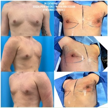 Grade I Gynecomastia with Liposuction