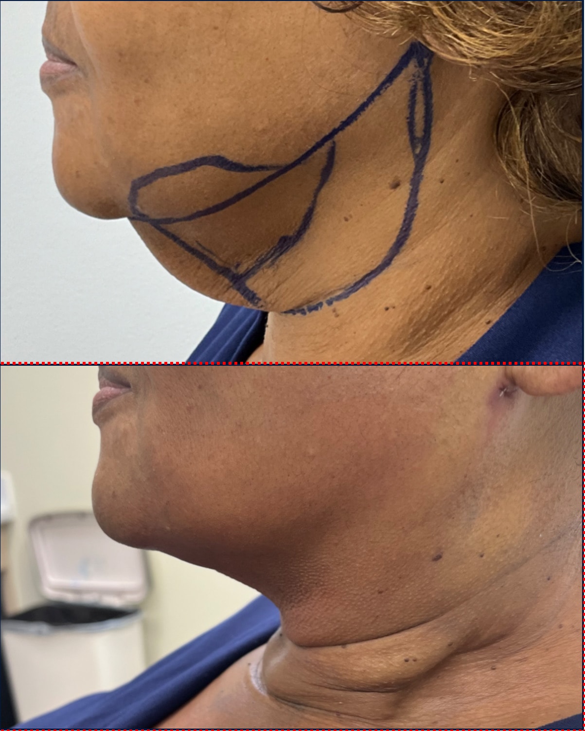 Case--3728 | Before and After Neck Liposuction 2