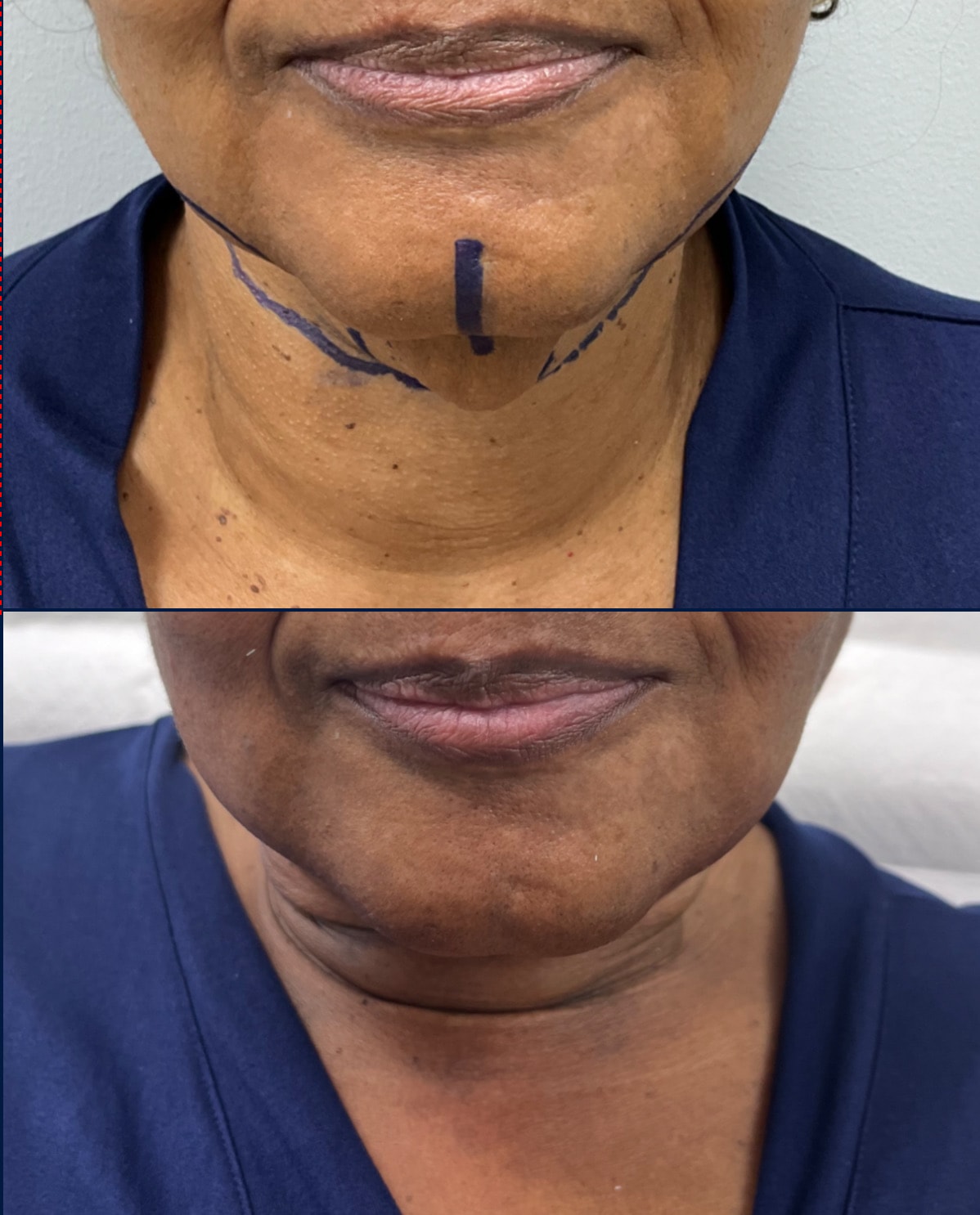 Case--3728 | Before and After Neck Liposuction