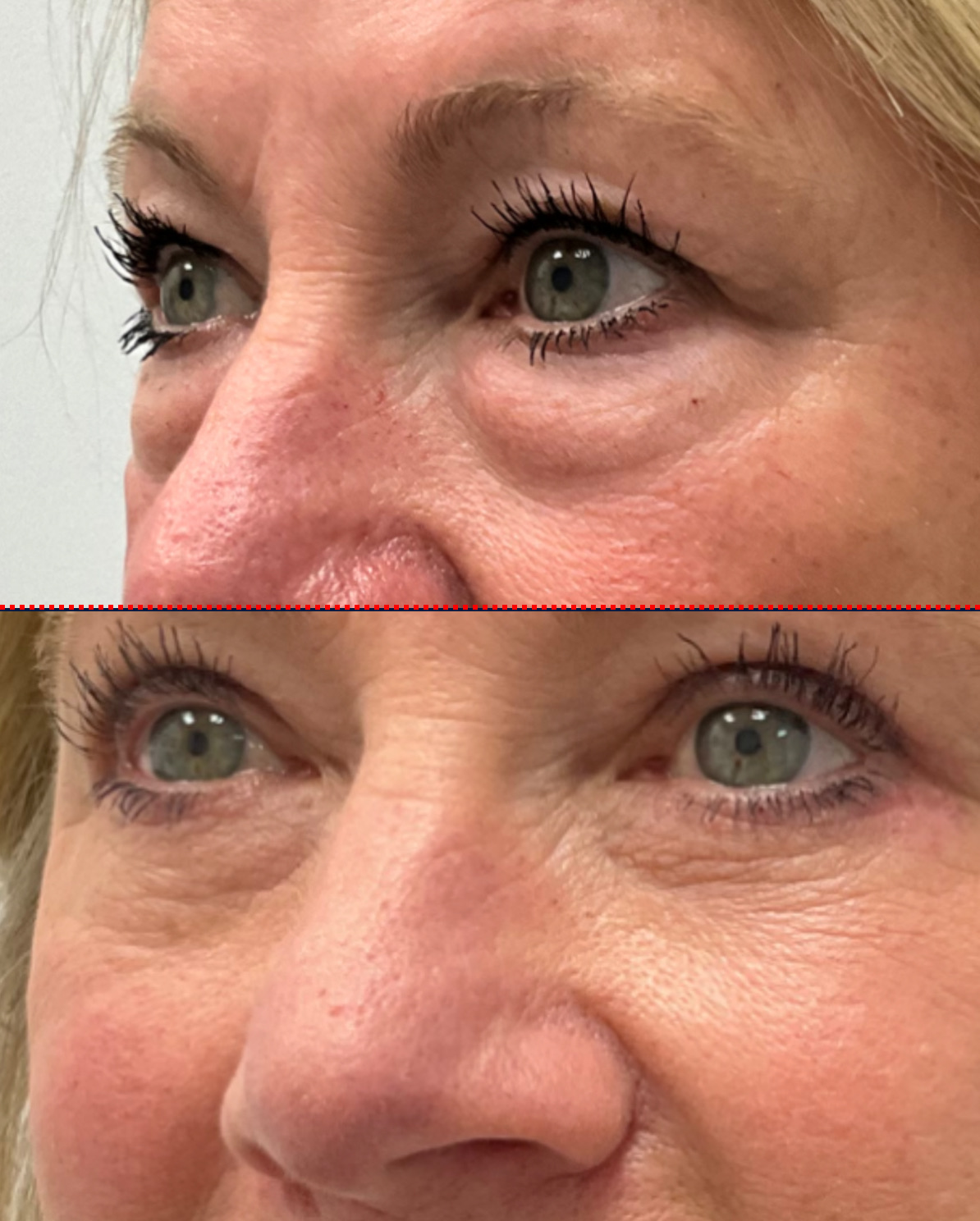 Case--6588 | Before and After Blepharoplasty 3