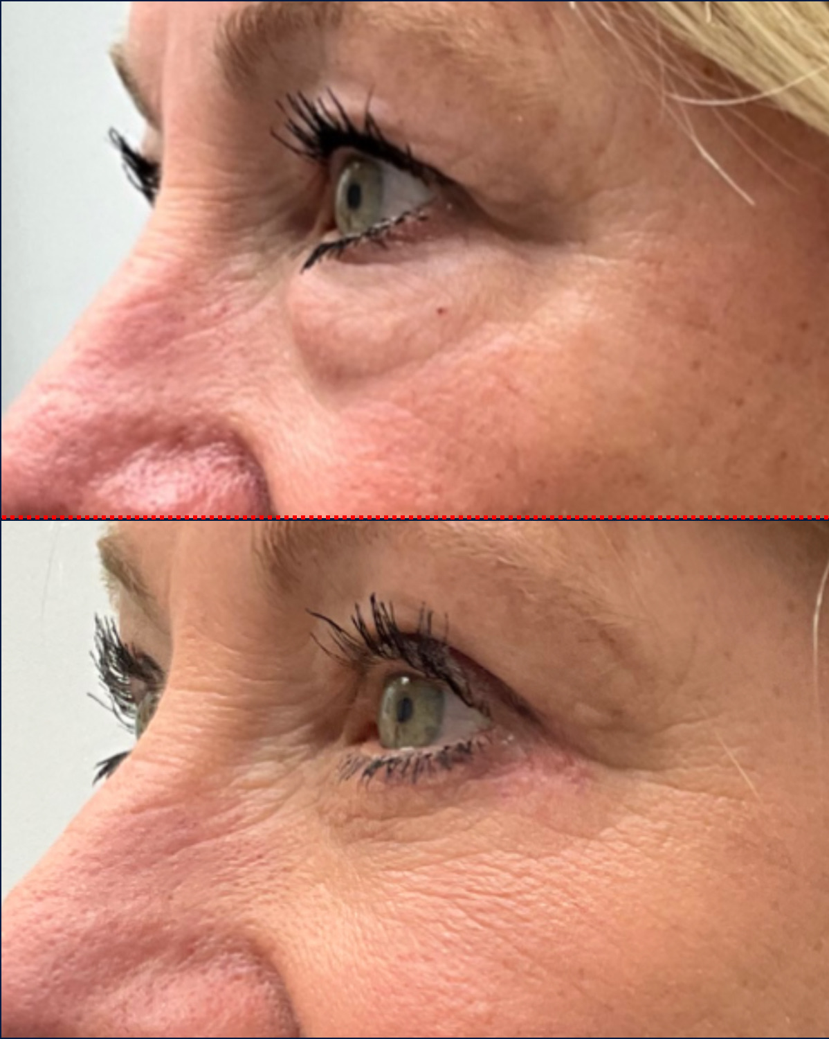 Case--6588 | Before and After Blepharoplasty 4